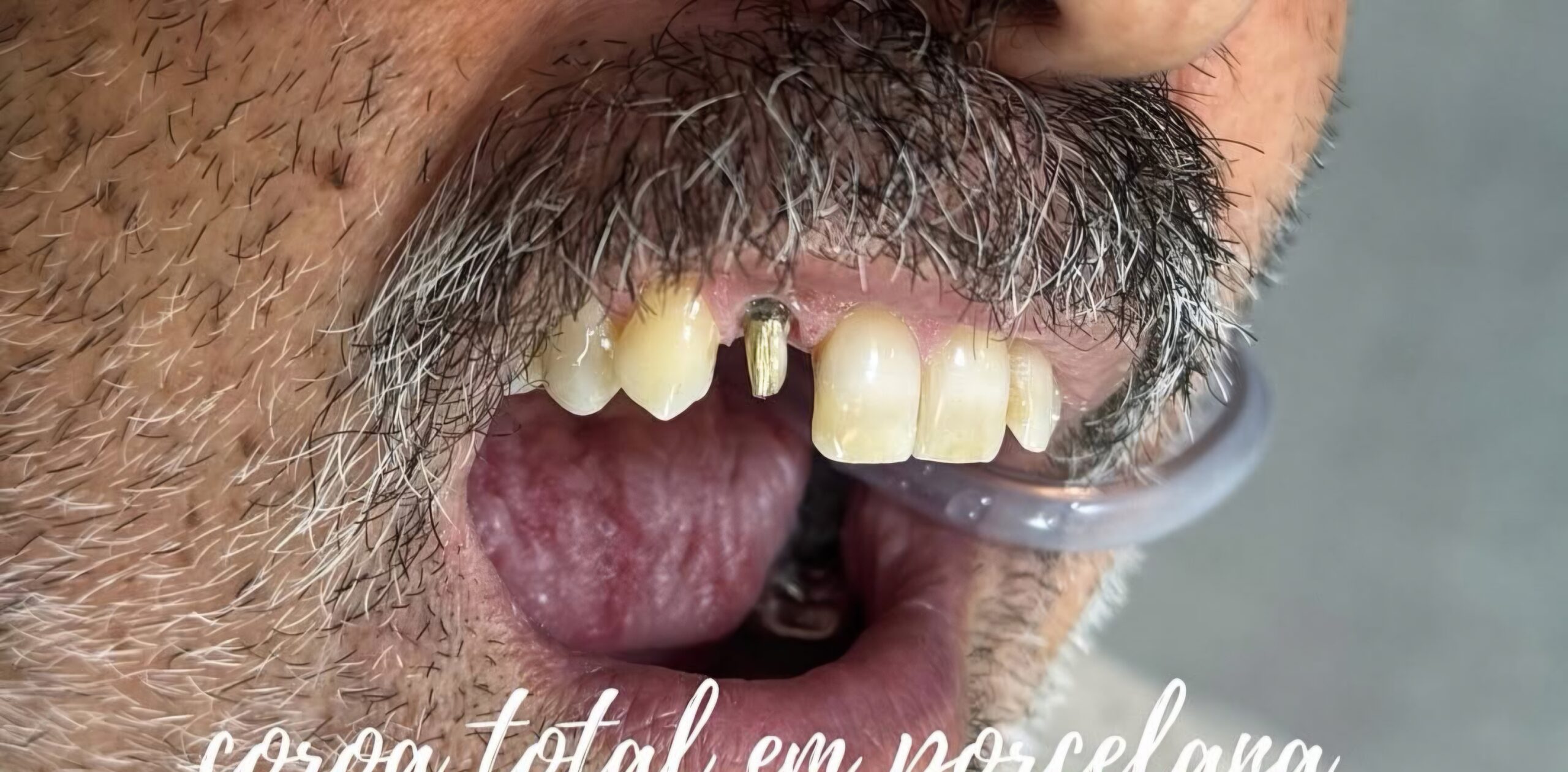 Antes — Implante Unitário